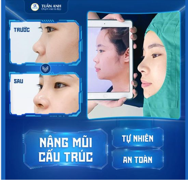 Ca tái khám nâng mũi đầu ngày cùng Thẩm mỹ Tuấn Anh ​​​​​​​ Chỉ với 45 phút thực hiện - mũi vào form như ý