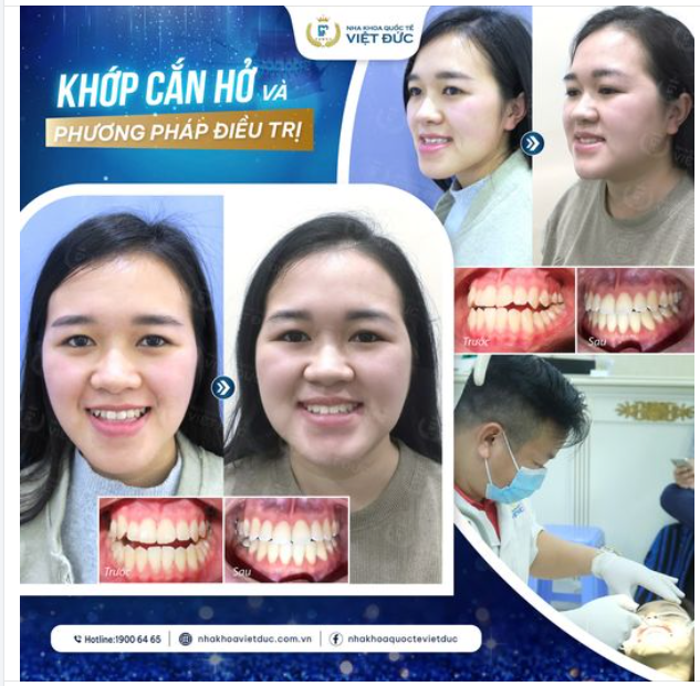 ĐỪNG COI NHẸ KHỚP CẮN HỞ ĐÃ ĐẾN LÚC BẠN CẦN THAY ĐỔI!