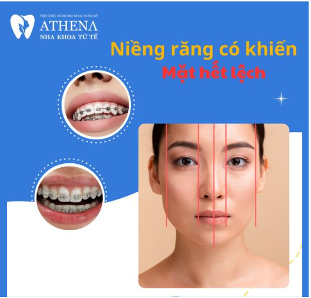 Niềng răng là phương pháp giúp cải thiện thẩm mỹ cho răng.