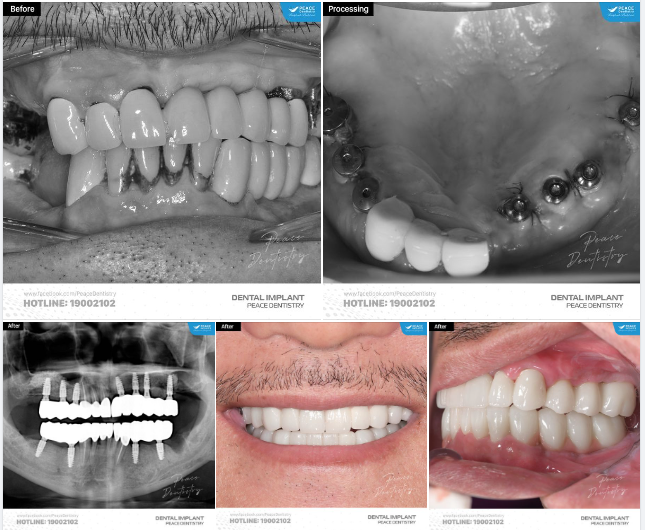 Năm 2020, chú đã đến Peace Dentistry với tình trạng răng miệng khá nghiêm trọng: mất nhiều răng, cầu răng sứ cũ đã xuống cấp, viêm nhiễm...