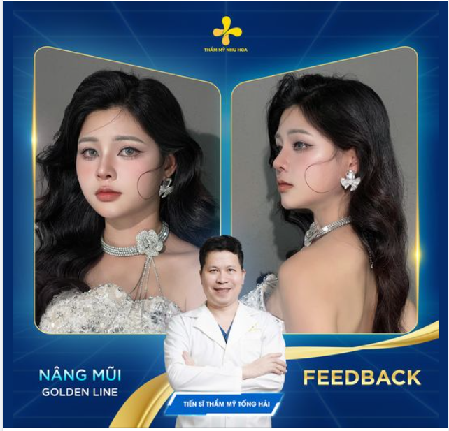 CHỊ ĐẸP Đỗ Lương sau 2 tháng nâng mũi Golden Line tại Thẩm mỹ Như Hoa 