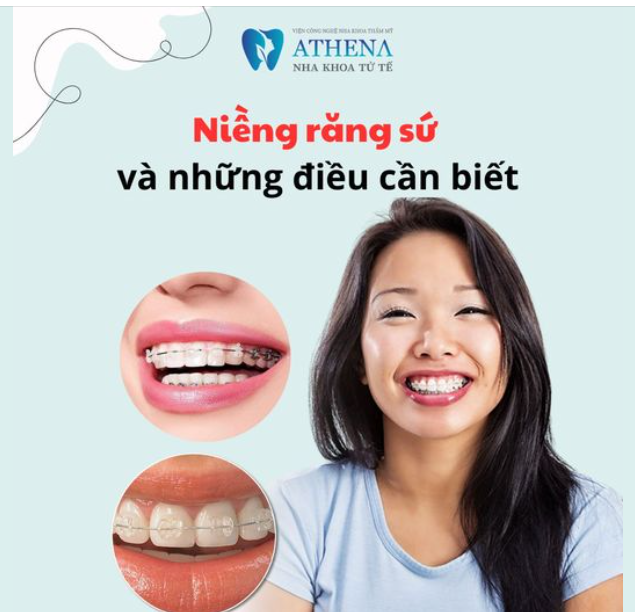 Với phương pháp niềng răng kim loại trước đây người đối diện sẽ dễ dàng nhận biết bạn đang niềng răng, gây mất thẩm mỹ với người đối diện.