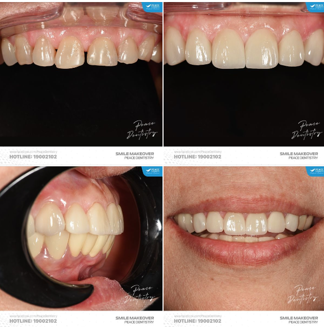 Vẫn là một ca lâm sàng  xâm lấn tối thiểu và mô răng thật được giữ lại gần như trọn vẹn với 6 mặt dán sứ veneer IPS e.max (Ivoclar Vivadent, Germany), bác sĩ Peace Dentistry chọn màu răng tương đồng với màu răng thật của khách hàng giúp cải t