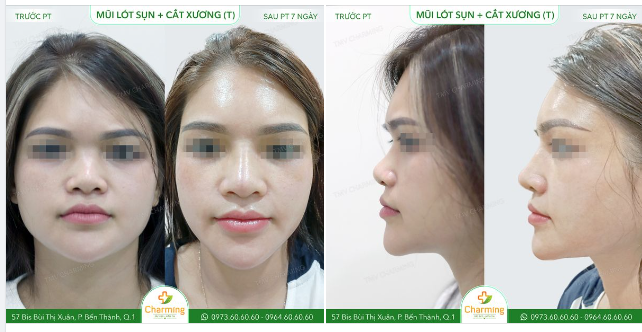 Với chiếc mũi cao, thẳng và dài hơn ban đầu, nàng khách của Charming giờ đây đã vui vẻ, hài lòng với gương mặt cân đối hơn, góc nghiêng cũng được "thần thánh hóa"