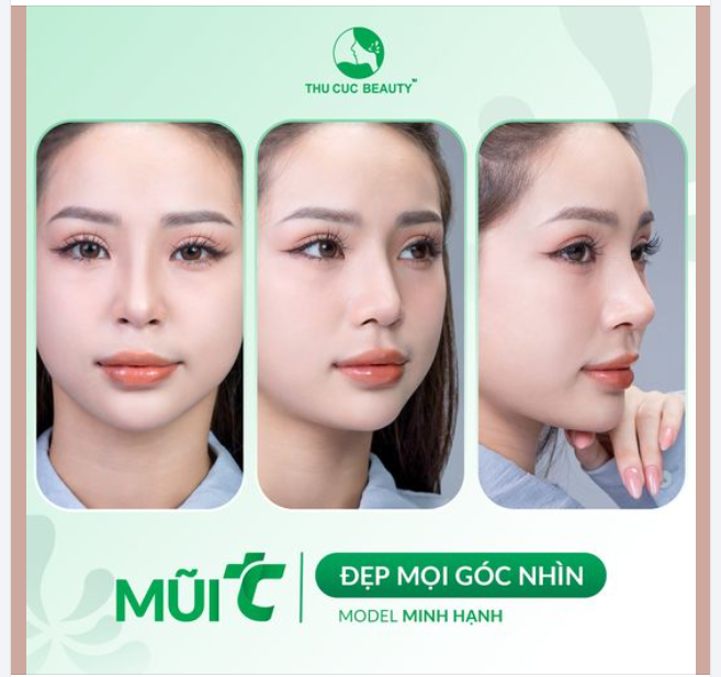 30P có ngay dáng mũi cân mọi góc chụp. Lựa chọn Mũi TC ngay hôm nay