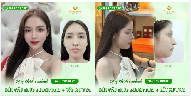 Nàng khách của Charming cứ mê tít, tâm đắc mãi với chiếc mũi đã được bác Khanh nâng mũi cấu trúc sụn sườn sửa lại với sụn surgiform.