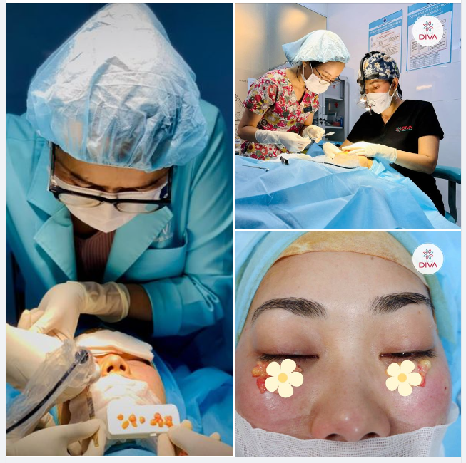 LẤY TÚI MỠ MÍ MẮT DƯỚI: TRẺ HÓA VÙNG MẮT