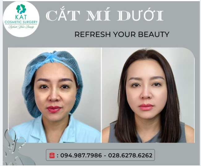“Thanh xuân trở lại chỉ với phẫu thuật cắt mí dưới ”