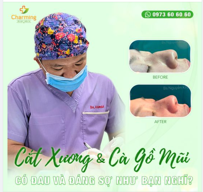 CẮT XƯƠNG MŨI HAY CÀ GỒ CÓ ĐÁNG SỢ NHƯ BẠN NGHĨ?