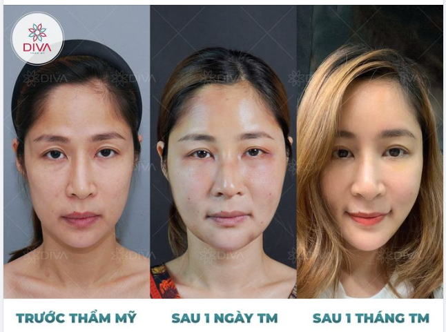 CẤY MỠ COLEMAN TRÁN: CẢI THIỆN TRÁN LÕM, HỒI XUÂN TỰ NHIÊN