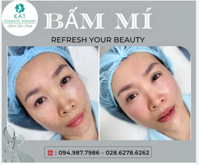 Trên 30 tuổi có nhấn mí được không? câu hỏi rất được nhiều chị em thắc mắc