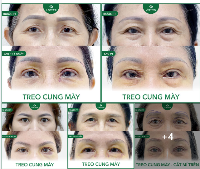 PHẪU THUẬT NÂNG CUNG MÀY