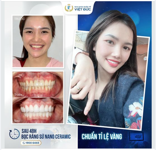 BỌC RĂNG SỨ NANOCERAMIC – CÔNG NGHỆ ĐỘC QUYỀN TẠI NHA KHOA QUỐC TẾ VIỆT ĐỨC