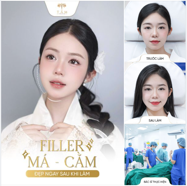 Làm filler xong khác quá! Má baby đáng yêu, cằm tròn đầy xinh xắn, thay đổi nhanh chóng chỉ sau 30 phút với combo filler má - cằm tại Tấm các nàng nhé.