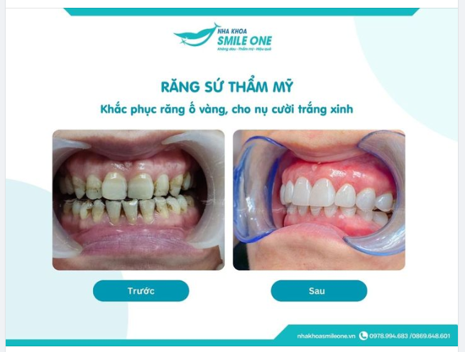 Một hàm răng ố vàng sẽ làm bạn kém sang.