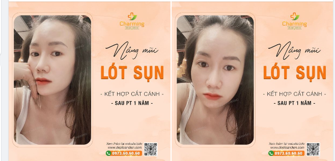 Khi kết hợp nâng mũi lót sụn và cắt cánh mũi, khuôn mặt của bạn sẽ được tôn lên một cách hoàn hảo, như nàng khách của Charming đây