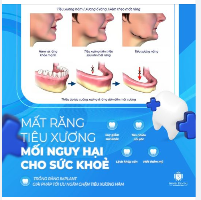 MẤT RĂNG TIÊU XƯƠNG HÀM - MỐI NGUY HẠI CHO SỨC KHOẺ