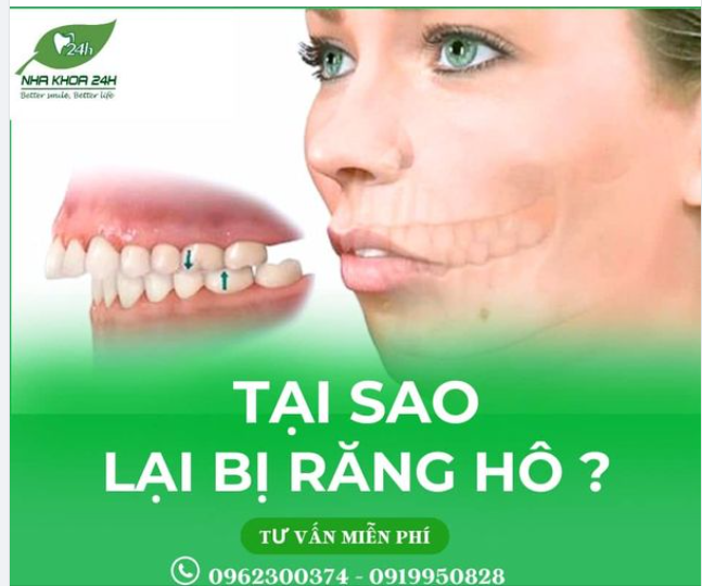 TẠI SAO LẠI BỊ RĂNG HÔ ​​​​​​​?