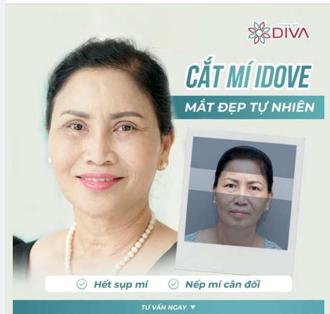TẠM BIỆT MÍ SỤP, MẮT MỘT MÍ SAU CẮT MÍ MẮT