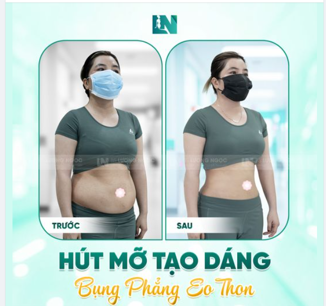 Đã đến lúc chia tay mỡ bụng nhiều ngấn lấy lại vóc dáng hoàn hảo nhờ dịch vụ thắt eo tạo dáng với tiêu chí thực hiện AN TOÀN và XINH ĐẸP