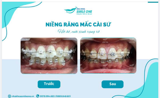Hết hô, cười xinh rạng rỡ với niềng răng mắc cài sứ