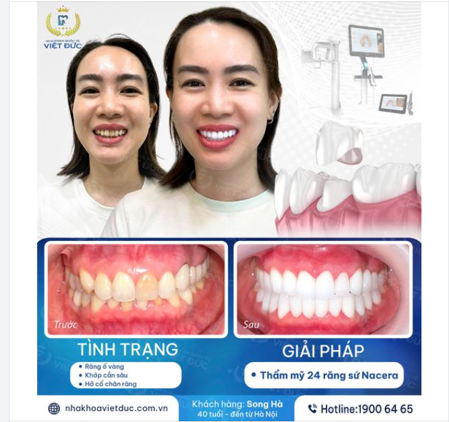 GIẢI PHÁP BỌC RĂNG SỨ NANOCERAMIC – MANG ĐẾN NỤ CƯỜI ĐẸP, CÓ HỒN