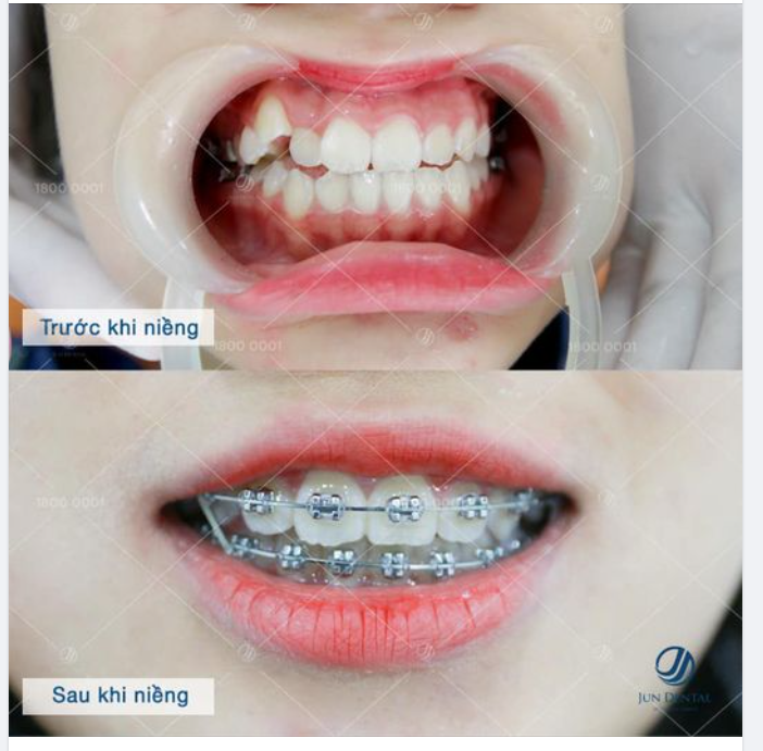 NIỀNG RĂNG KHOẢNG BAO LÂU THÌ ĐƯỢC THÁO ?