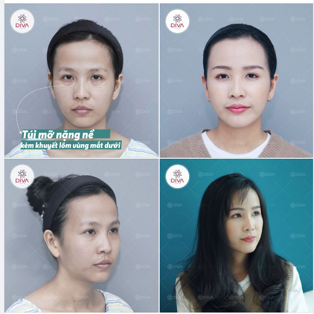 BỌNG M.Ỡ NẶNG NỀ VÀ KHUYẾT LÕM VÙNG MẮT DƯỚI GÂY ẢNH HƯỞNG ĐẾN THẦN THÁI KHUÔN MẶT NHƯ THẾ NÀO?