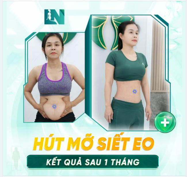 Flex với cả nhà kết quả sau 1 tháng thực hiện hút mỡ bụng siết eo của chị khách nè