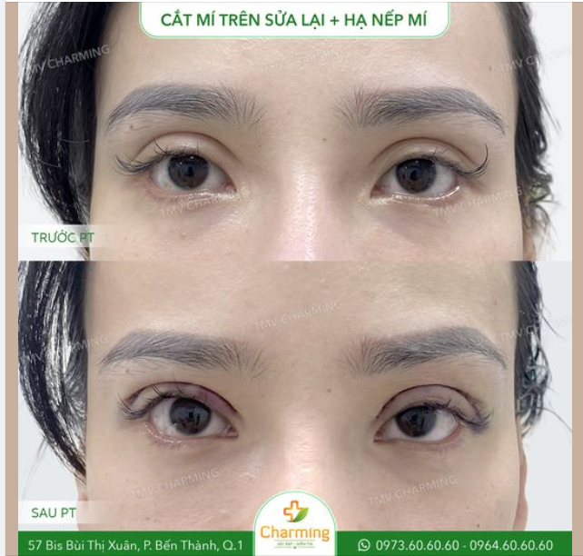 Khi đã bỏ ra một số tiền để thực hiện phẫu thuật, chắc chắn ai cũng muốn có được kết quả như ý.