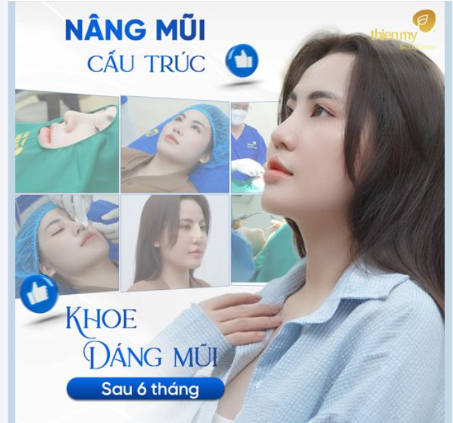 Nâng mũi cấu trúc - Khoe dáng mũi sau 6 tháng