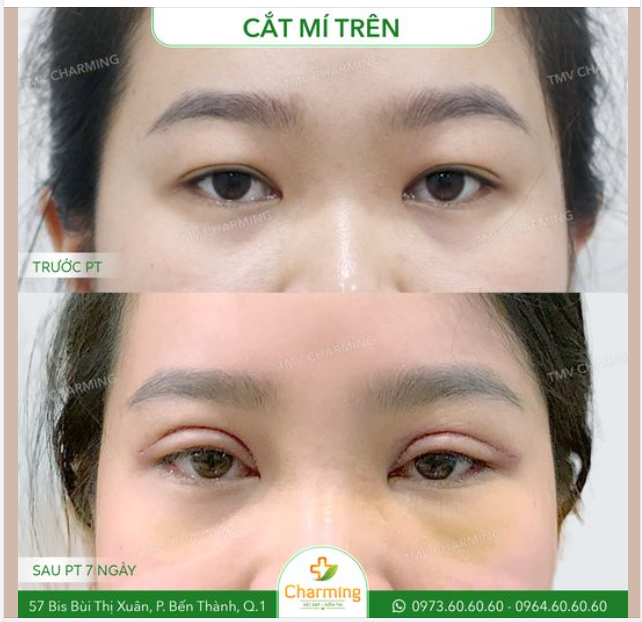 Phương pháp CẮT MÍ TRÊN tại TMVCharming giúp các nàng sở hữu đôi mắt to tròn, rõ nếp mí khắc phục nhiều tình trạng mắt như: