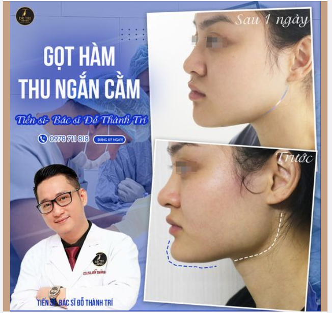 Khác biệt rõ rệt Trước- Sau 1 ngày Gọt hàm và Thu ngắn cằm