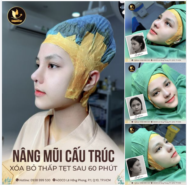 NÂNG MŨI CẤU TRÚC - 60 PHÚT XÓA BỎ MŨI THẤP TẸT