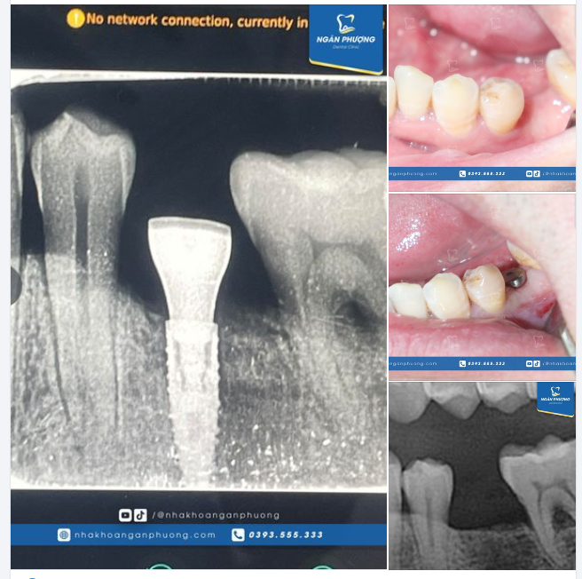 TOP 3 LỢI ÍCH KHI PHỤC HÌNH IMPLANT SỚM
