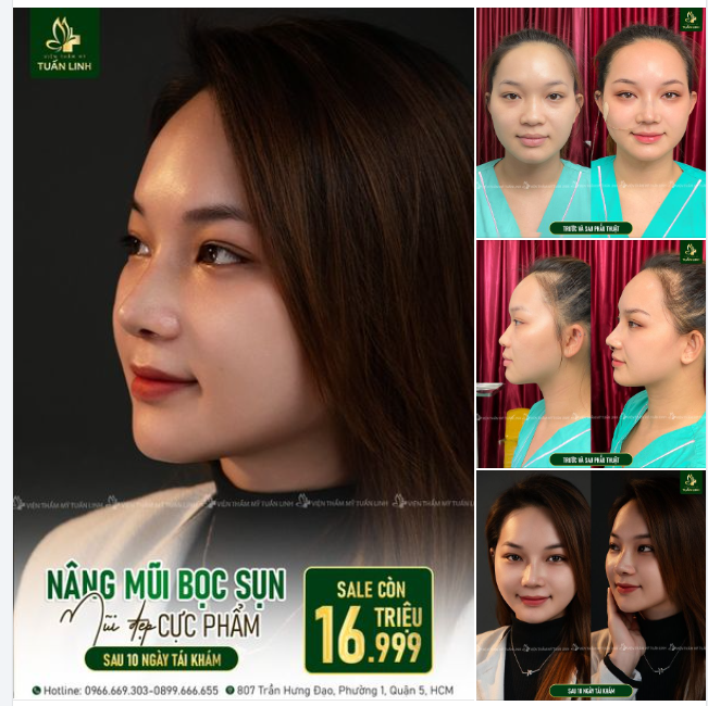 CHỈ VỚI 16TR999 TRIỆU - SỞ HỮU NGAY DÁNG MŨI ''CỰC PHẨM'' CHỈ SAU 10 NGÀY!!