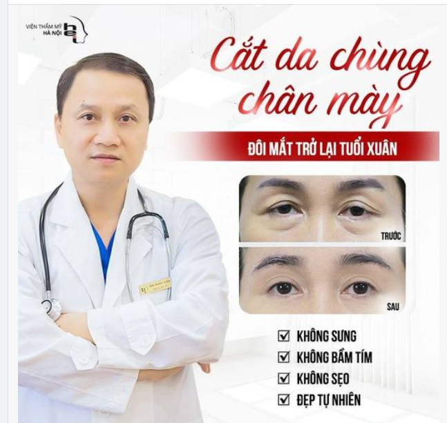 Vì sao phải thực hiện Cắt da chùng chân mày