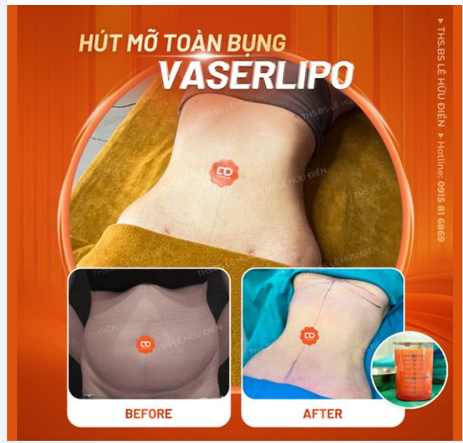 KẾT QUẢ SAU 1 THÁNG KHÁCH HÀNG HÚT MỠ VASERLIPO TẠI DRD.