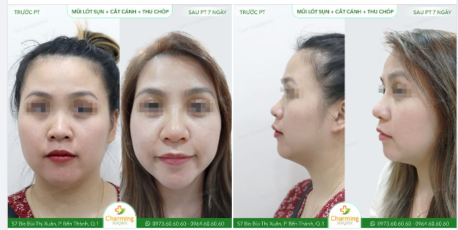 Chỉ mới sau phẫu thuật 7 ngày thôi nên phần mũi của nàng khách vẫn còn hơi sưng, nhưng dù vậy mọi người cũng sẽ dễ dàng nhận ra sự thay đổi tích cực ở gương mặt của nàng khách đó nha