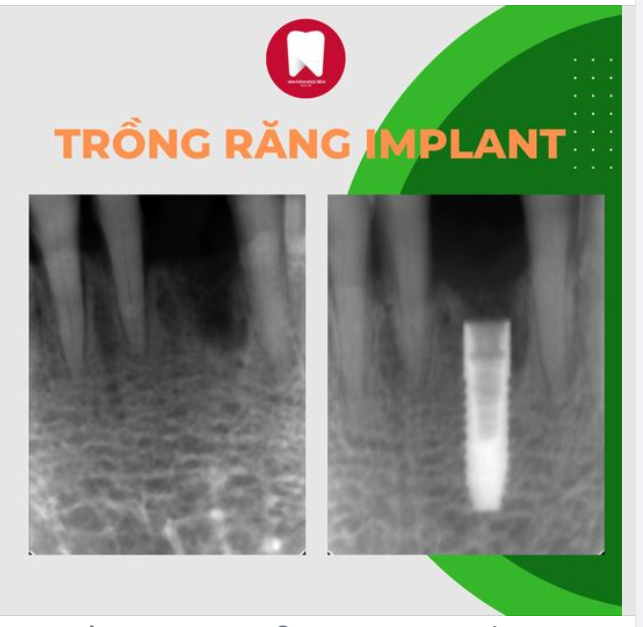 Trụ implant khi trồng vào xương hàm sẽ như thế nào