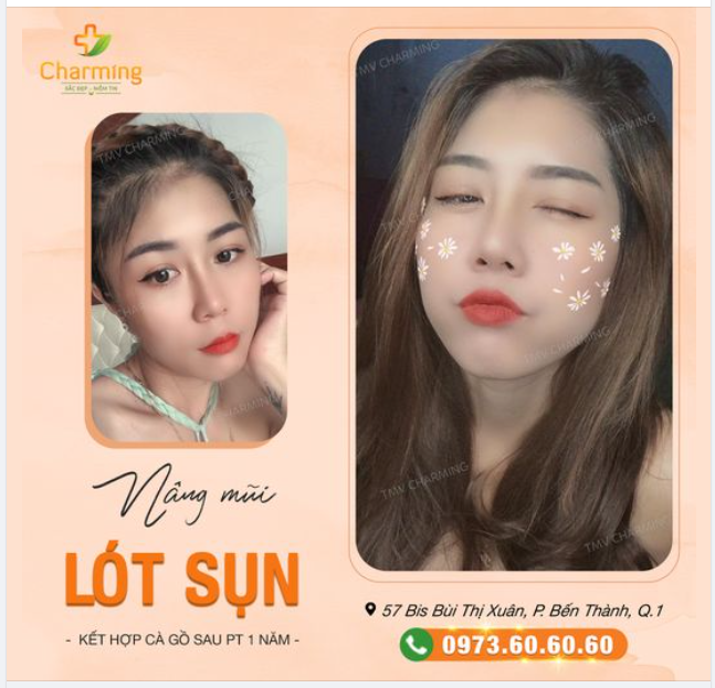 Có thể nói combo nâng mũi lót sụn kết hợp cà gồ là combo yêu thích của nhiều khách hàng Charming, trong đó có cả nàng khách đây
