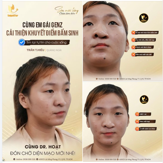 Gặp khuyết điểm hở môi hàm ếch bẩm sinh, Trần T. Hiếu tìm đến Bác sĩ Hoạt - Saigon Star với mơ ước nhỏ nhoi là có thể tự tin tháo bỏ lớp khẩu trang, hòa mình với cuộc sống bình thường.