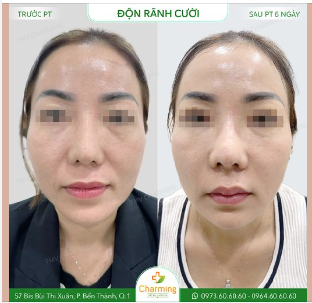 Charming không cần nói quá nhiều thì mọi người vẫn ngay lập tức nhận ra sự khác biệt rõ rệt ở nàng khách sau khi nàng độn rãnh cười tại Charming đúng không nào?