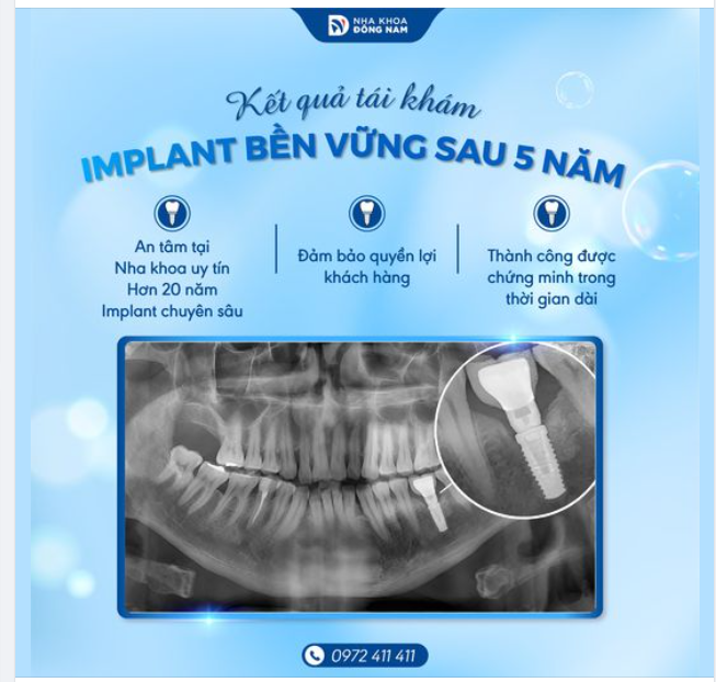 RĂNG IMPLANT SAU 5 NĂM: BẰNG CHỨNG RÕ RÀNG VỀ ĐỘ BỀN VÀ HIỆU QUẢ