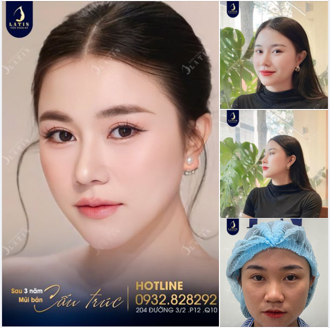 Em Gái Feedback Sau 3 Năm Nâng Mũi Bán Cấu Trúc
