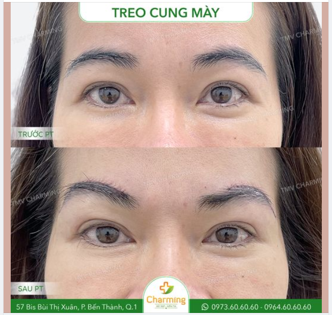 Trước khi thực hiện treo cung mày tại Charming, khuôn chân mày của nàng khách khá cong và phần đuôi cụp.