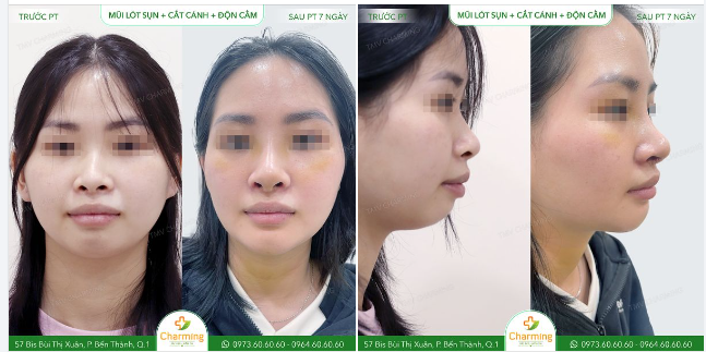 Nàng khách đã thực hiện nâng mũi lót sụn kết hợp cắt cánh mũi và độn cằm tại Charming.