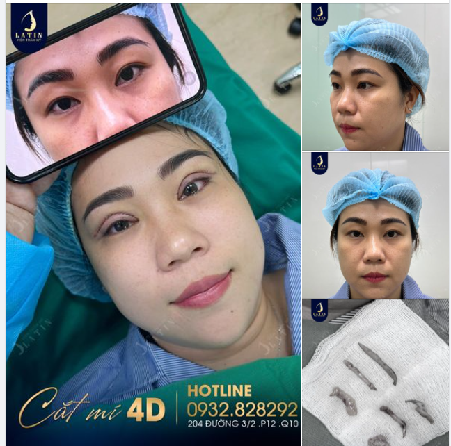 Chị Gái Với Đôi Mắt Mới Sau Khi Cắt Mí 4D Tại Latin