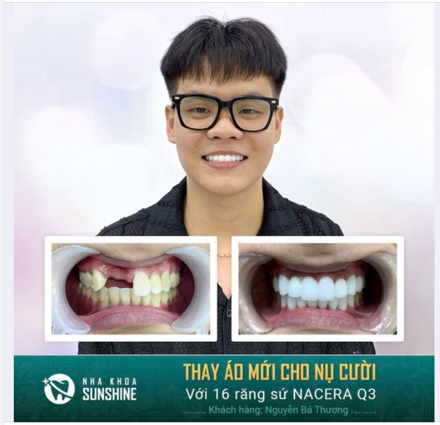 THAY ÁO MỚI CHO NỤ CƯỜI VỚI 16 RĂNG SỨ NACERA Q3