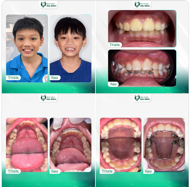 NIỀNG RĂNG SỚM CHO CON - QUYẾT ĐỊNH SÁNG SUỐT CỦA CHA MẸ